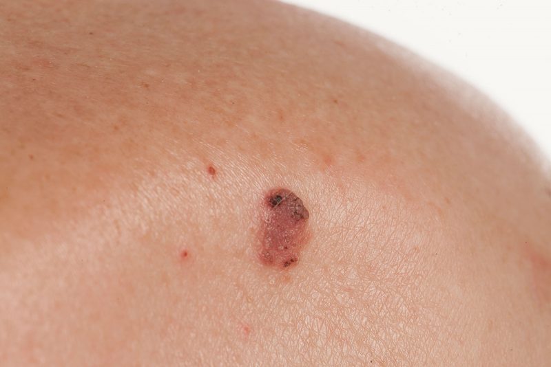 port_macquarie_skin_cancer_clinic_4