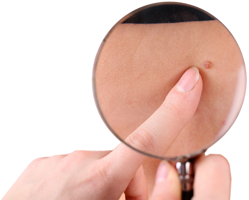 skin-cancer-2