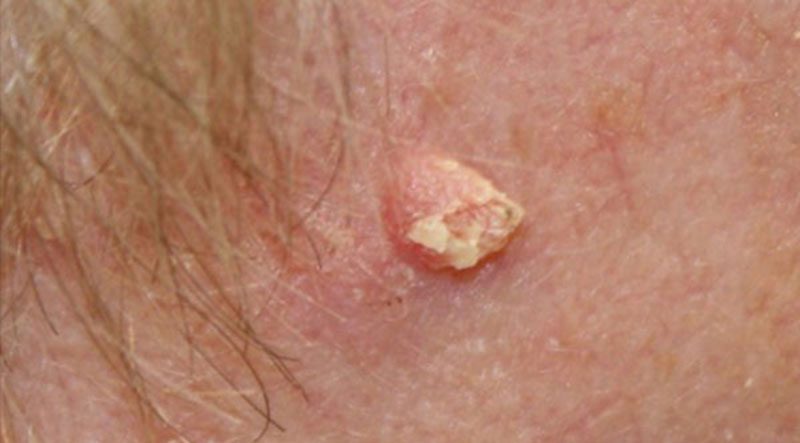 Squamous-Cell-Carcinoma Squamous-Cell-Carcinoma